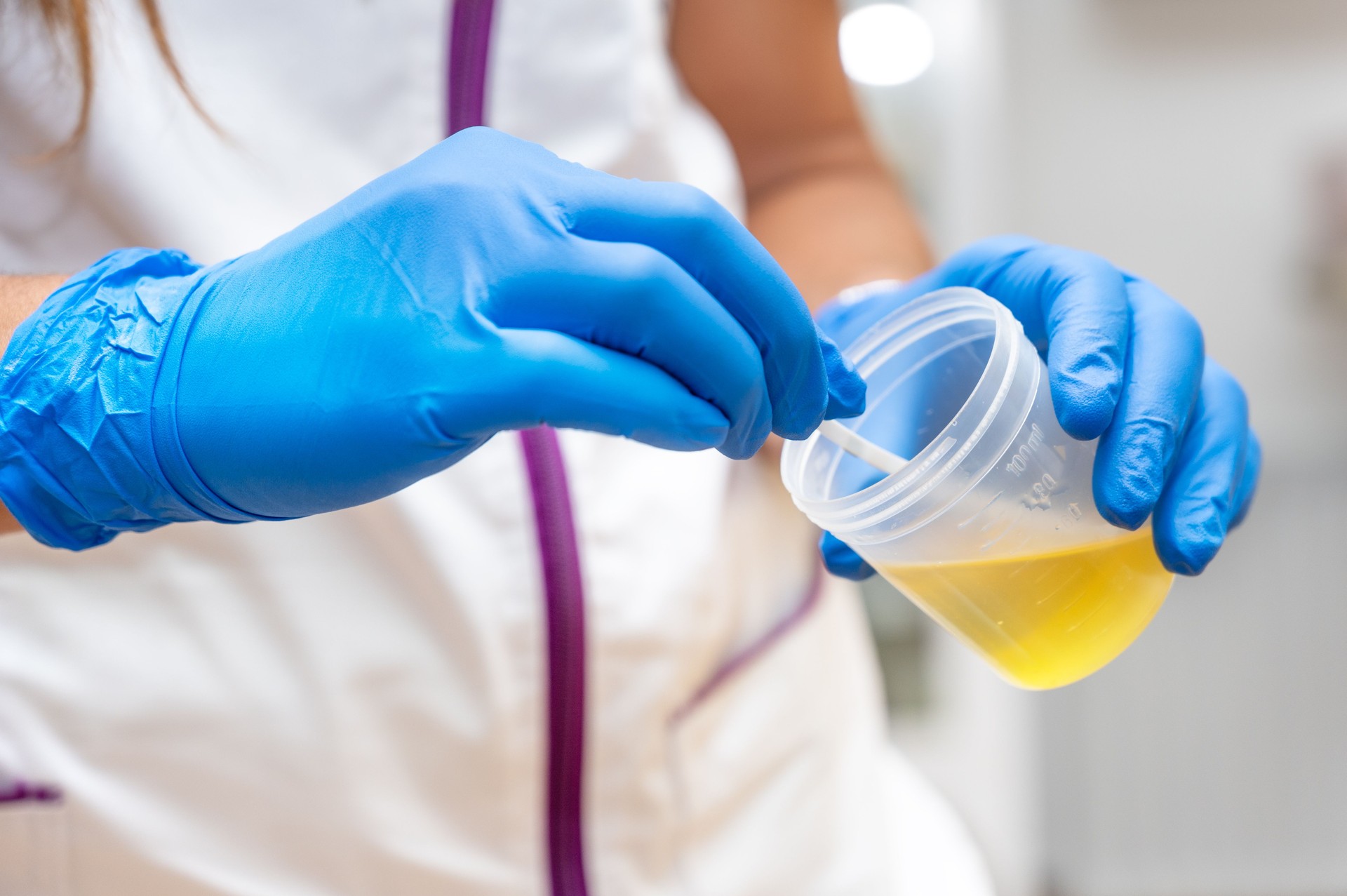 Close up of Nurse Hand holding urine sample container for medical urine analysis with color strip. High quality photo
